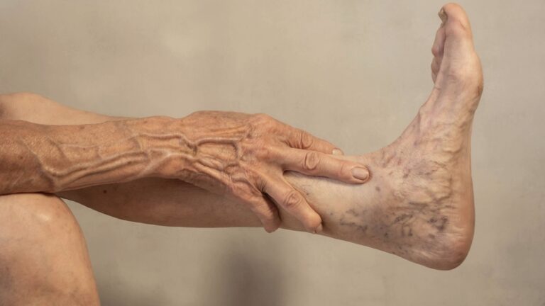 Veins on the legs. Varicose veins on the leg of an elderly woman.